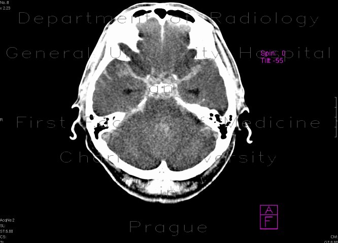 Subarachnoid hemorrhage