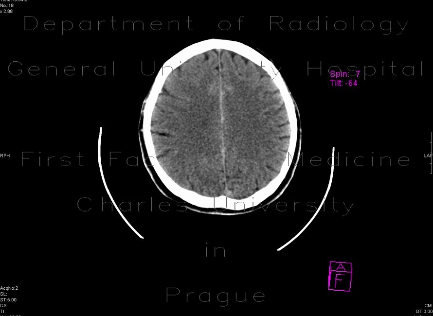 Subarachnoid hemorrhage