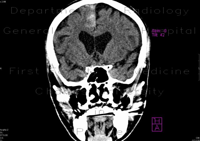 Subarachonid hemorrhage, minute