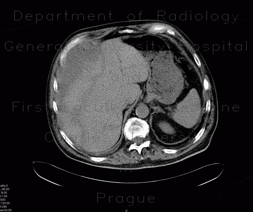 Subcapsular hematoma of the liver