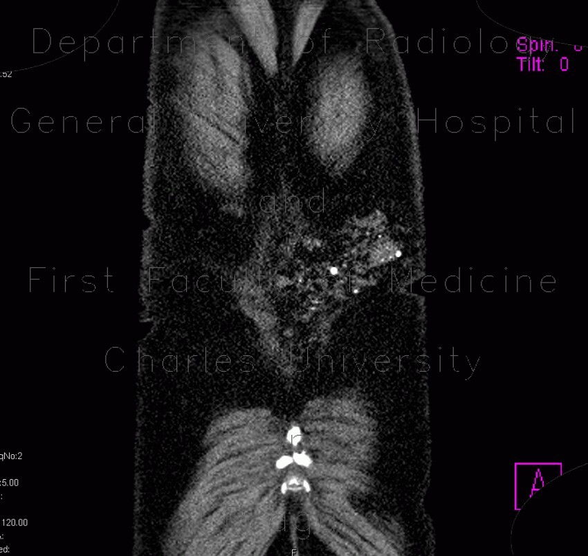 Subcutaneous hemangioma