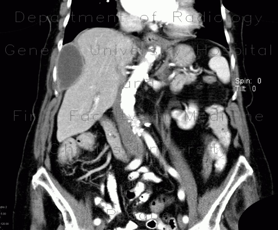 Subdiaphragmatic abscess, abscess