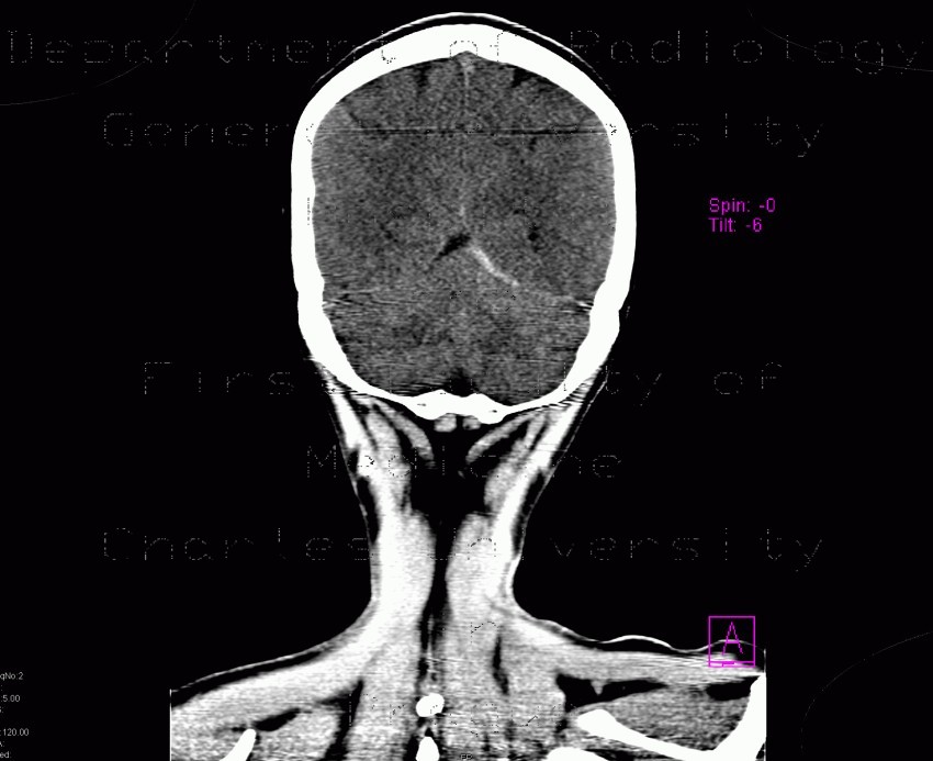 Subdural hematoma on tentorium