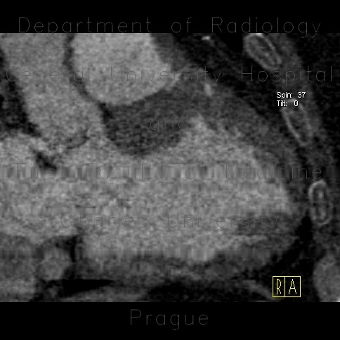 Subendocardial infarct of posterior wall of the left ventricle