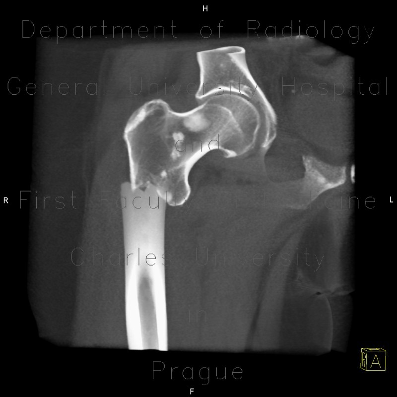 Subtrochanteric fracture of femur, pathologic fracture, bone metastasis, VRT