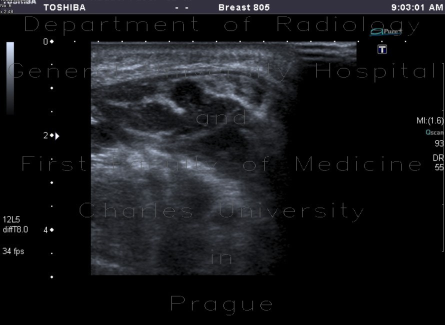 Suppurative sialoadenitis