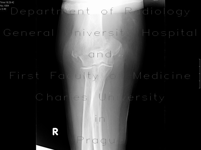 Supracondylic fracture of humerus