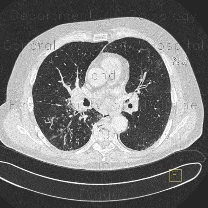 Terminal bronchiolitis, tree-in-bud