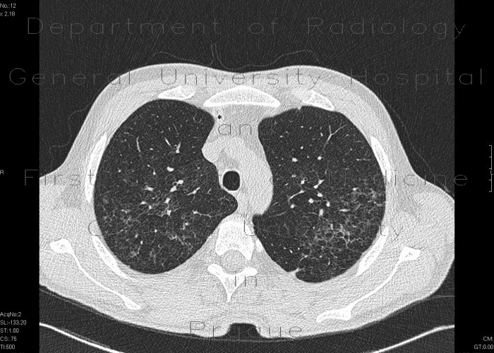 Thickening of intralobular interstitium, HRCT