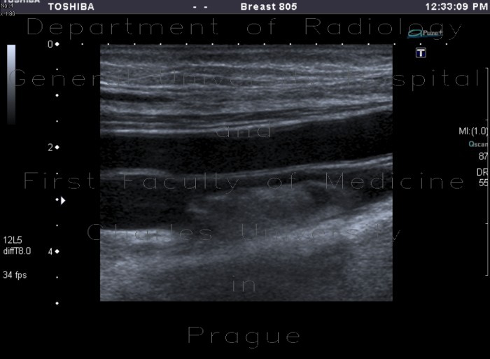 Thrombosis of femoral vein, subacute