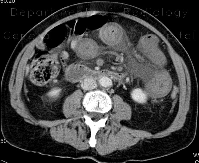 Thrombosis of mesenteric and portal vein, venous infarction of small bowel loops