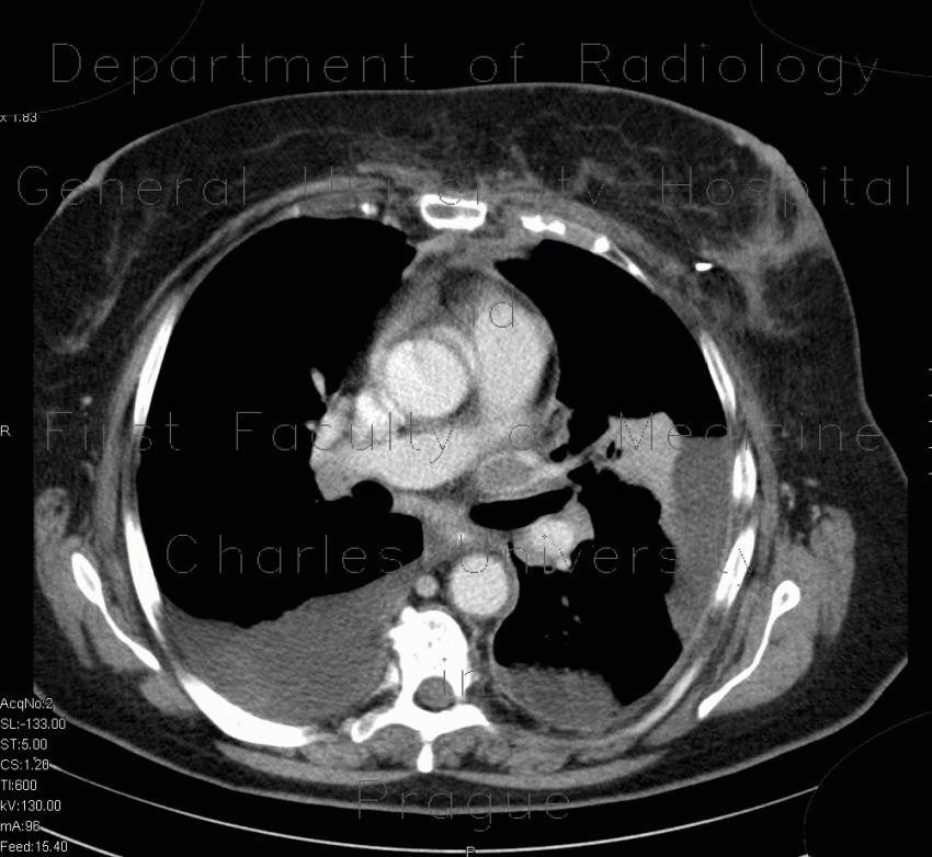 Thrombosis of pulmonary vein