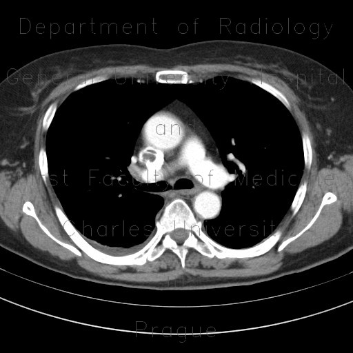 Thrombosis of superior vena cava