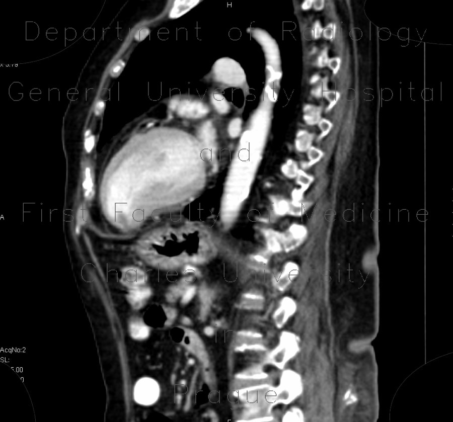 Thrombus in left ventricle, incidental finding