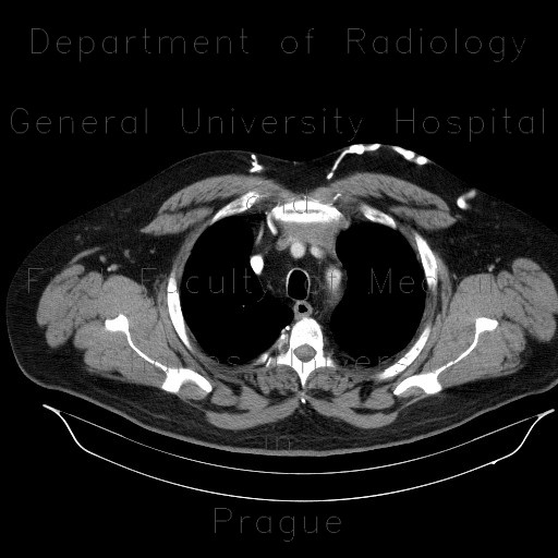 Thymoma, compression of the brachiocephalic vein, collateral flow