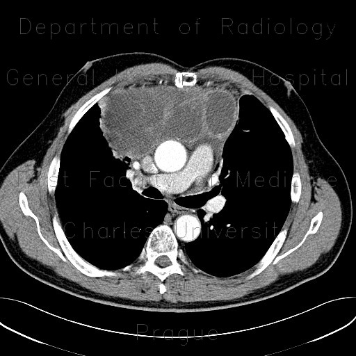 Thymoma, malignant thymoma