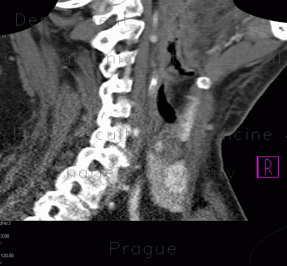 Thyroid nodule, hypervascular
