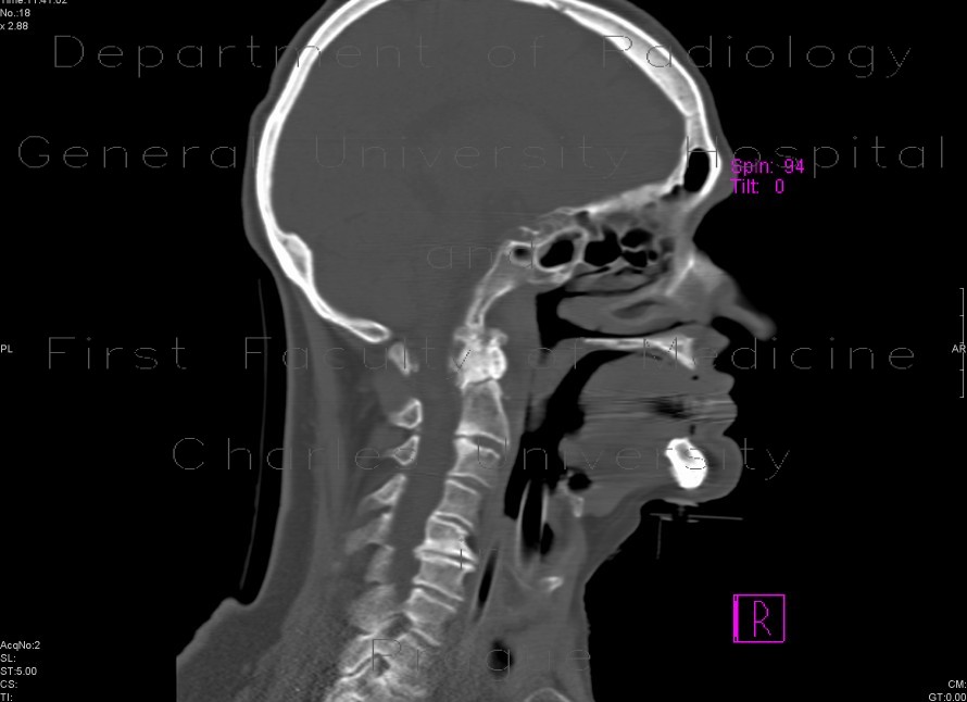 Transverse fracture of the dens axis