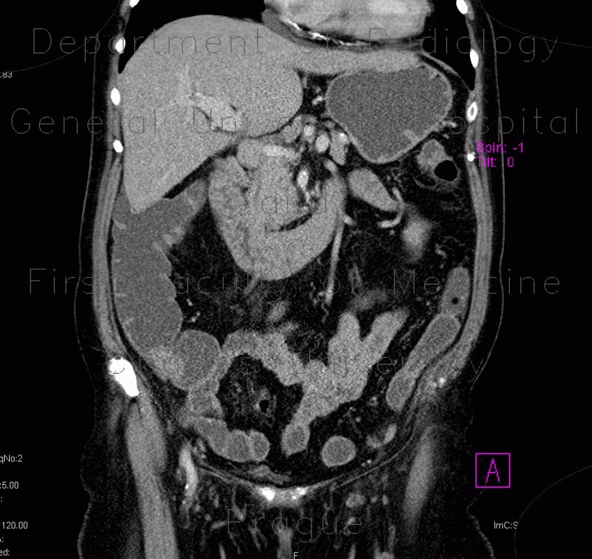Tumor of cecum, enterography