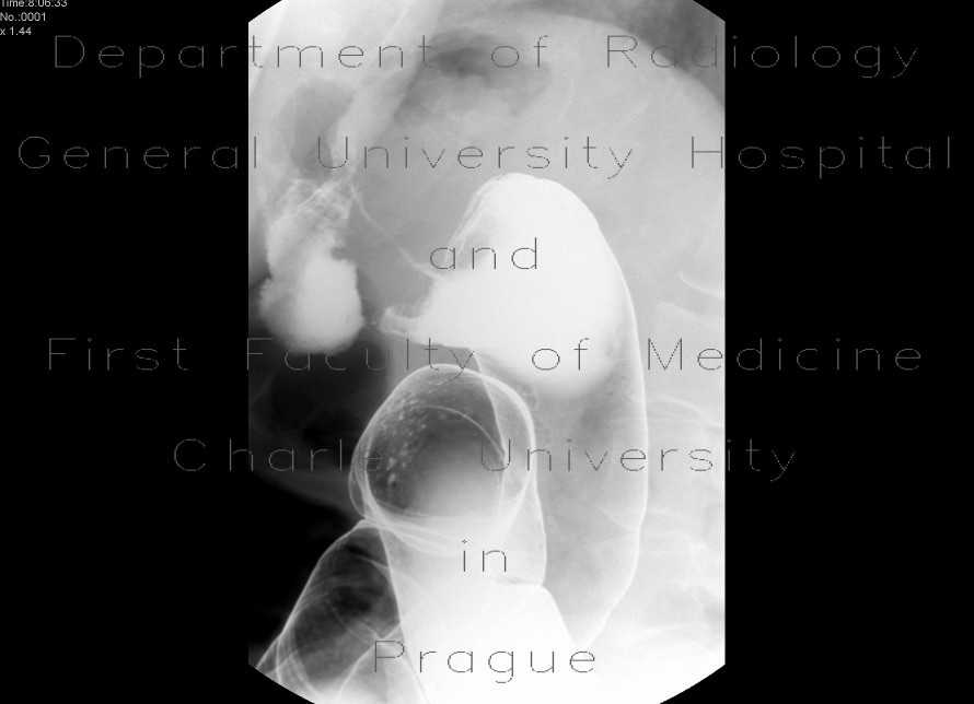 Tumorous stenosis of lienal flexure, severe stenosis, barium enema