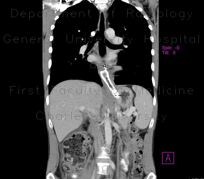 Tumorous stenosis of oesophagus, stent