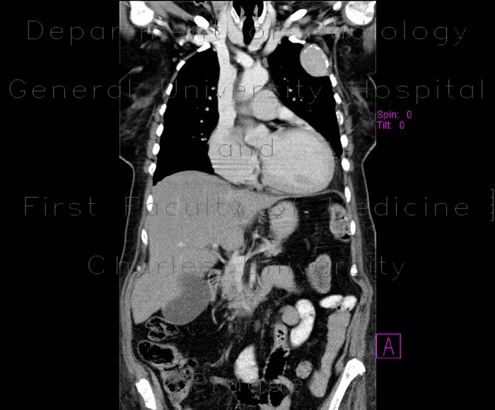 Tumour of chest wall, osteolysis of rib