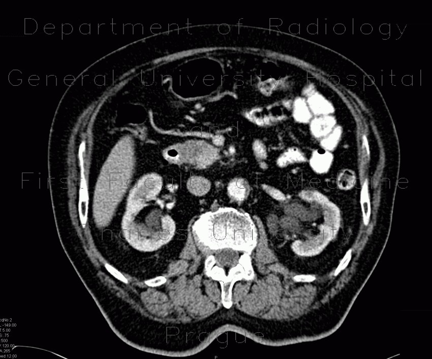 Tumour of pancreatic head