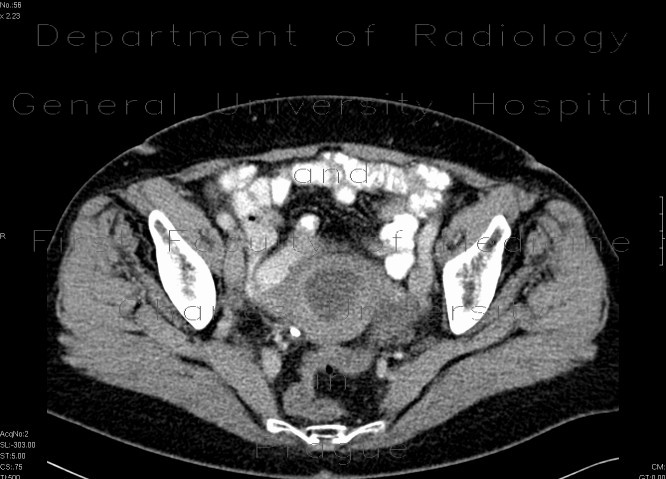 Tumour of the cervix of uterus, hydronephrosis