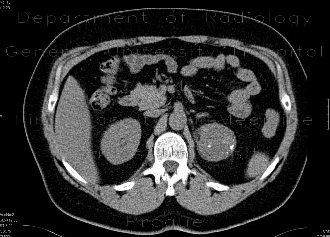 Tumour of the left adrenal gland, adenoma