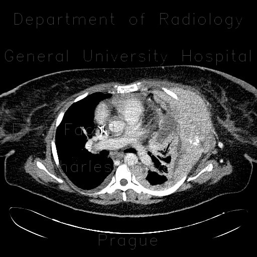 Tumour of thorax wall