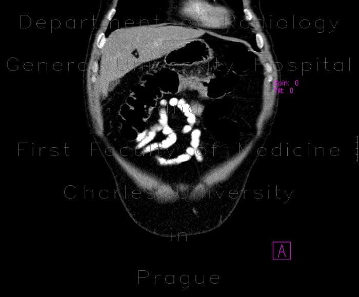 Tumour of transverse colon