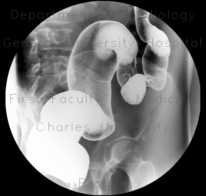 Ulcerative colitis, barium enema, irrigography