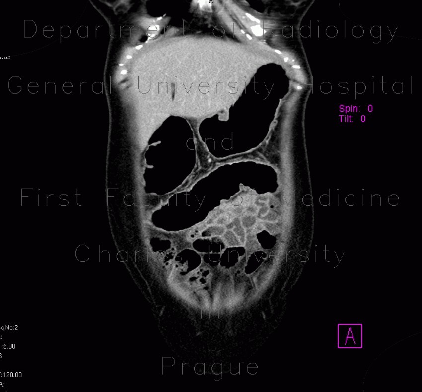 Ulcerative colitis, enterography