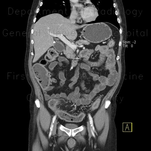 Ulcerative colitis, enterography