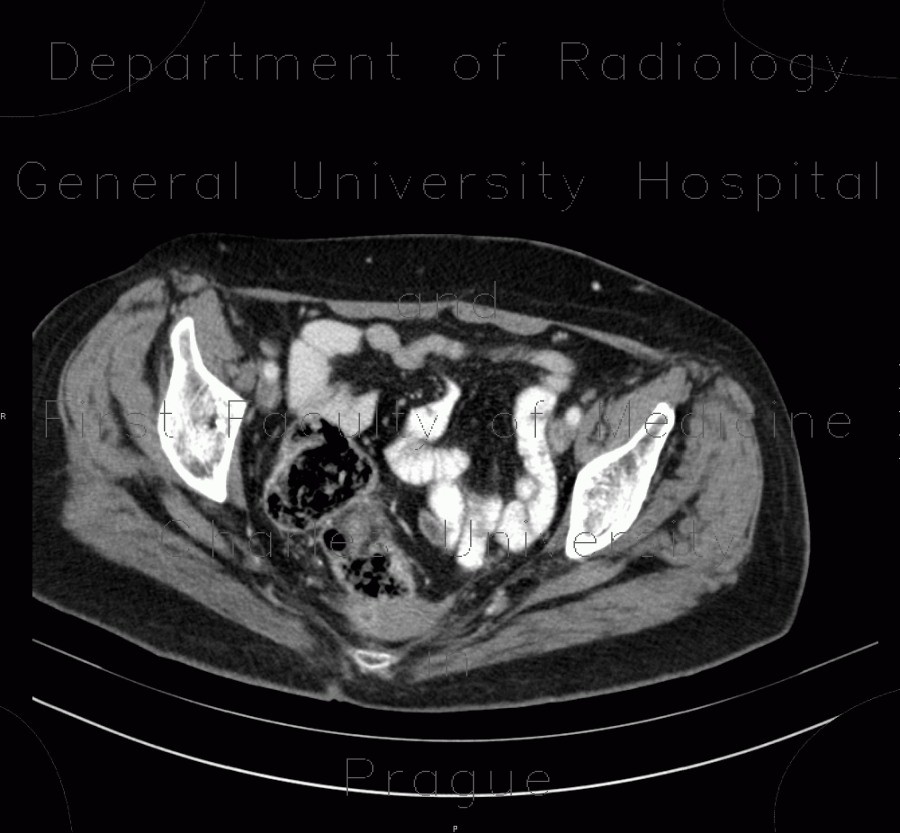Uterus, mimics a presacrall mass, extirpation of anus