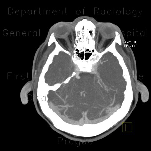 Venous angioma of cerebellum