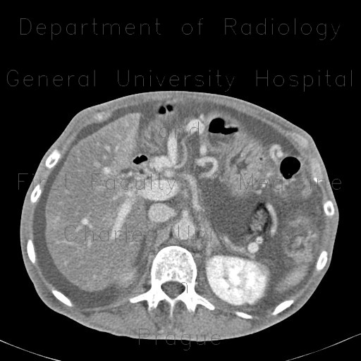Venous congestion, thrombosis of superior mesenteric vein, ascites, steatosis of liver