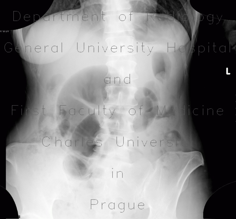 Volvulus of sigmoid colon, coffee bean sign