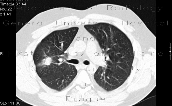 Wegener's granulomatosis, HRCT