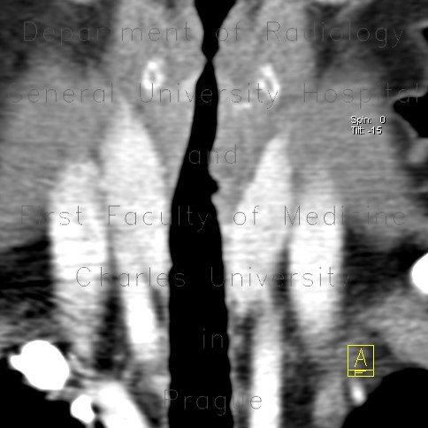 Wegener's granulomatosis of trachea