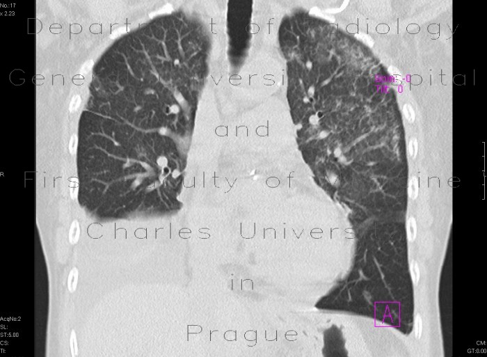 Wegener's vasculitis, sequel of pneumorhagia, alveolar bleeding