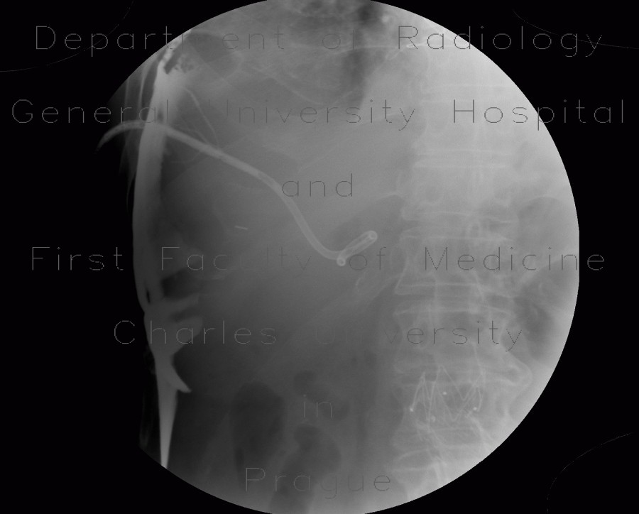 Whipple procedure, hepatico-jejuno anastomosis, biliary ascites, leak of anastomosis