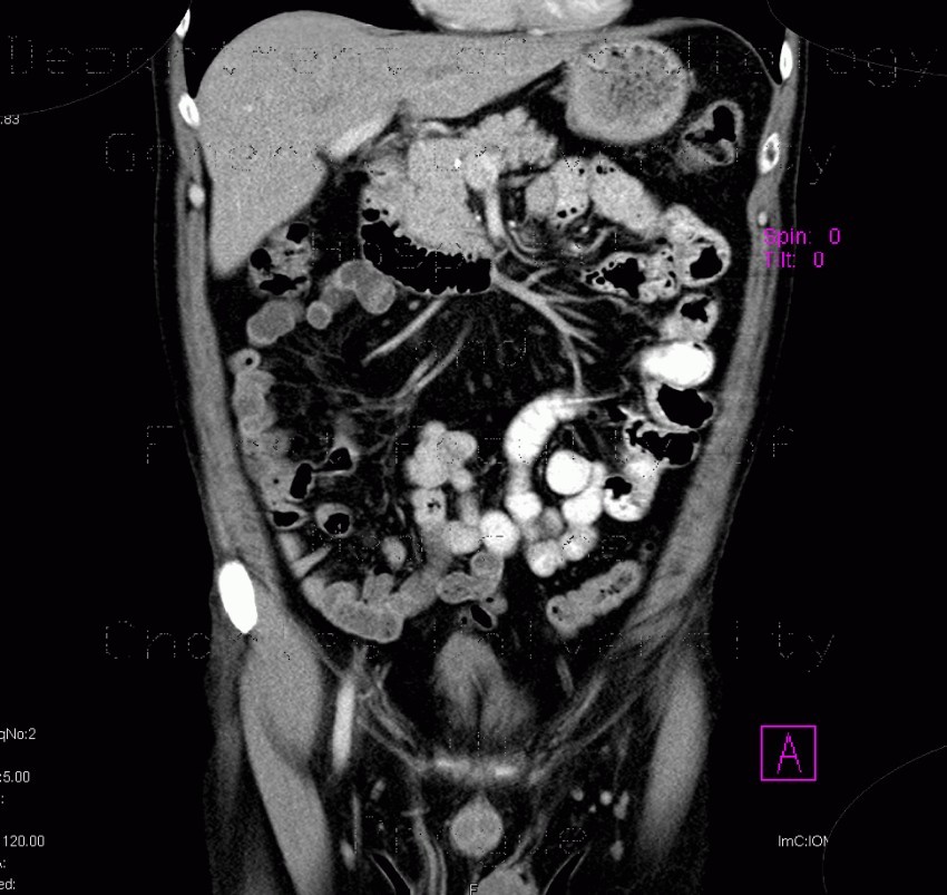 Wirsungolithiasis