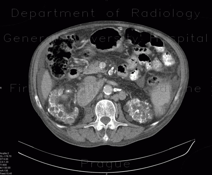 Xanthogranulomatous pyelonephritis