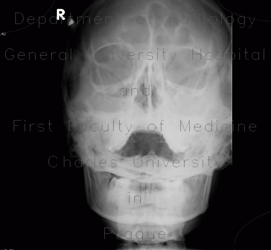 pansinusitis, sinusitis, acute, Water's view