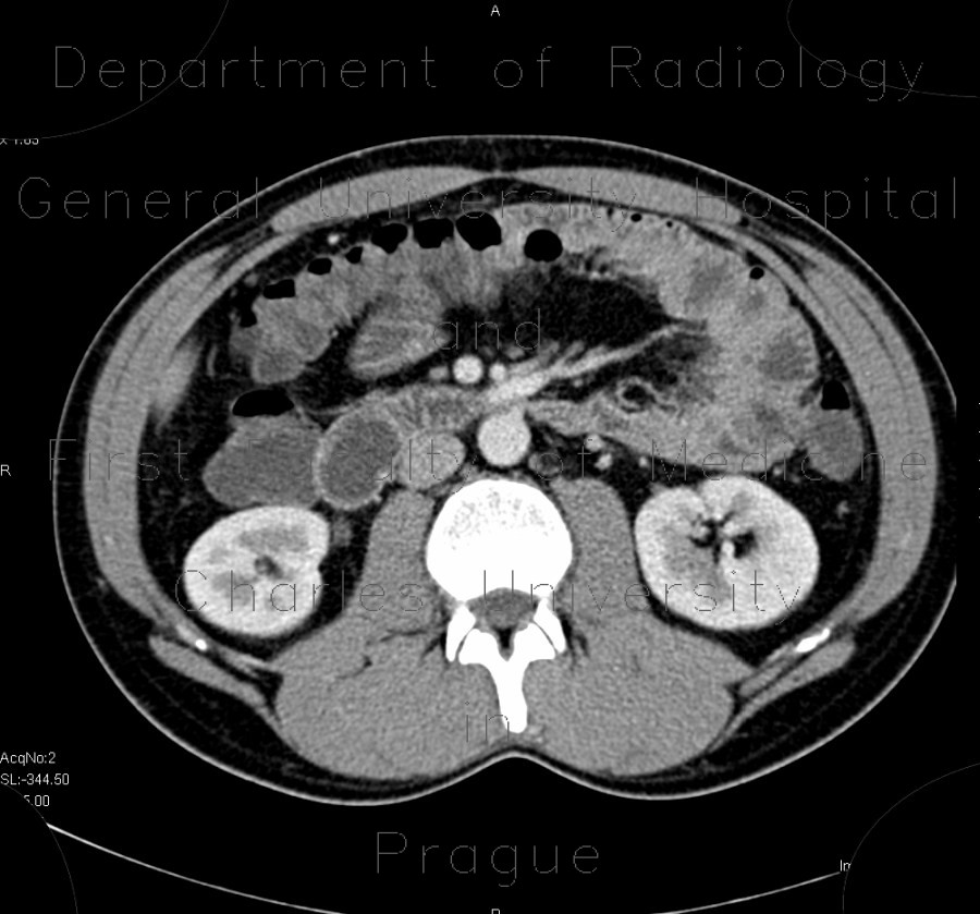 superior mesenteric artery syndrome, aortomesenteric compression